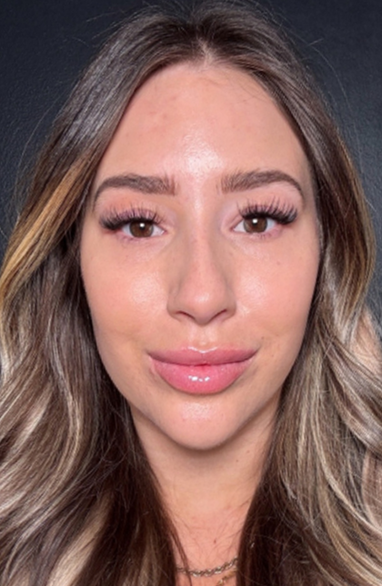 Microneedling Before & After Patient #16686