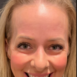 CO2 Laser Before & After Patient #16695