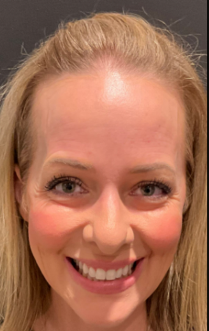 CO2 Laser Before & After Patient #16695