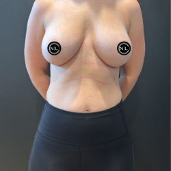 Breast Augmentation Before & After Patient #16681