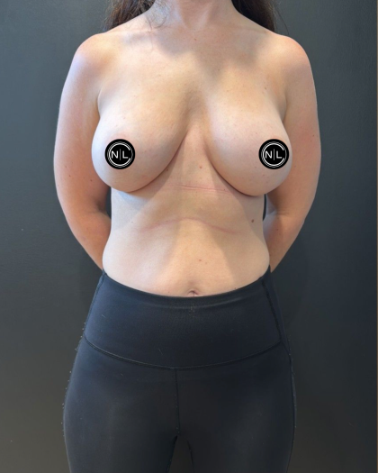 Breast Augmentation Before & After Patient #16681