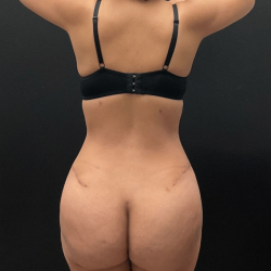 Brazilian Butt Lift Before & After Patient #16689