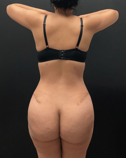 Brazilian Butt Lift Before & After Patient #16689