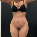 Mommy Makeover Before & After Patient #16691