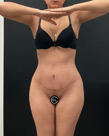 Mommy Makeover Before & After Patient #16691