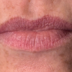 Lip Filler Before & After Patient #16693