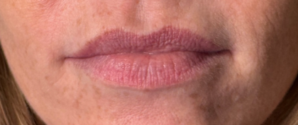 Lip Filler Before & After Patient #16693
