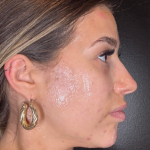 Microneedling Before & After Patient #16686