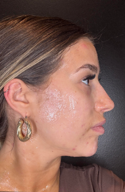 Microneedling Before & After Patient #16686