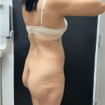 Brazilian Butt Lift Before & After Patient #16689