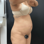 Mommy Makeover Before & After Patient #16691