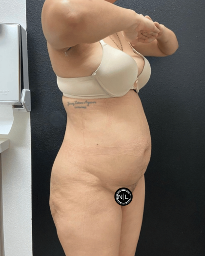 Mommy Makeover Before & After Patient #16691