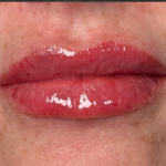 Lip Filler Before & After Patient #16693