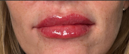 Lip Filler Before & After Patient #16693