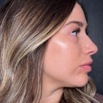 Microneedling Before & After Patient #16686