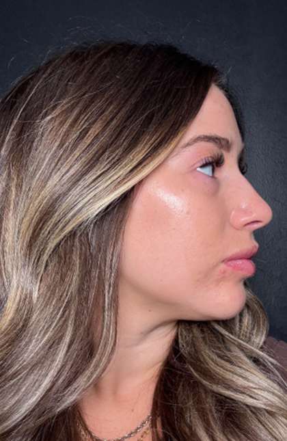 Microneedling Before & After Patient #16686