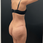 Brazilian Butt Lift Before & After Patient #16689