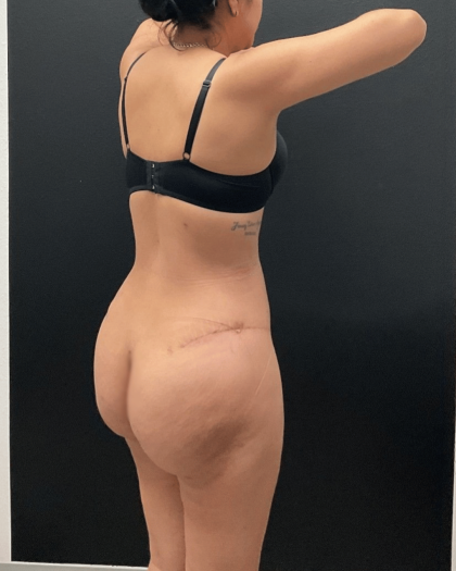 Brazilian Butt Lift Before & After Patient #16689