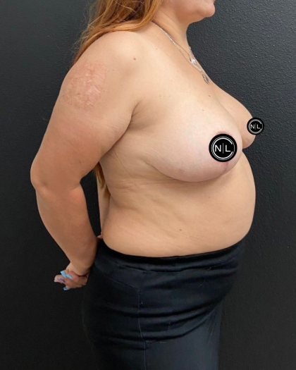 Breast Reduction Before & After Patient #16688