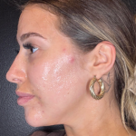 Microneedling Before & After Patient #16686