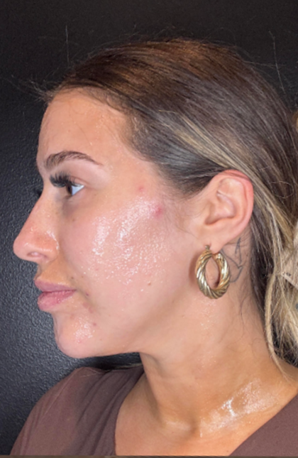 Microneedling Before & After Patient #16686