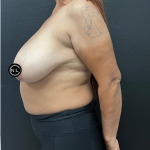 Breast Reduction Before & After Patient #16688