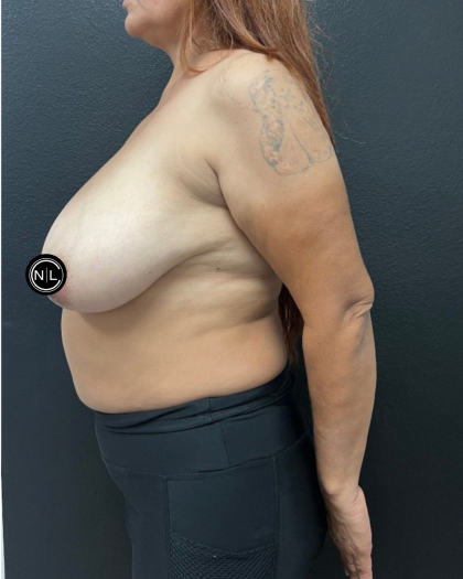 Breast Reduction Before & After Patient #16688