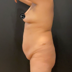 Mommy Makeover Before & After Patient #16690