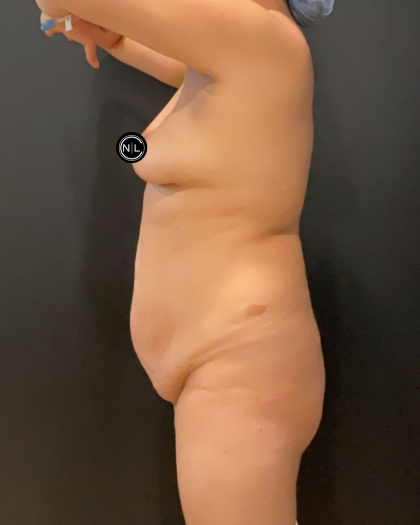 Mommy Makeover Before & After Patient #16690