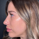 Microneedling Before & After Patient #16686