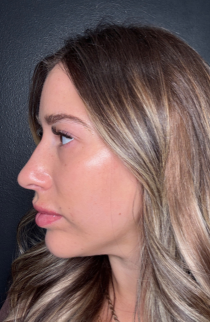 Microneedling Before & After Patient #16686