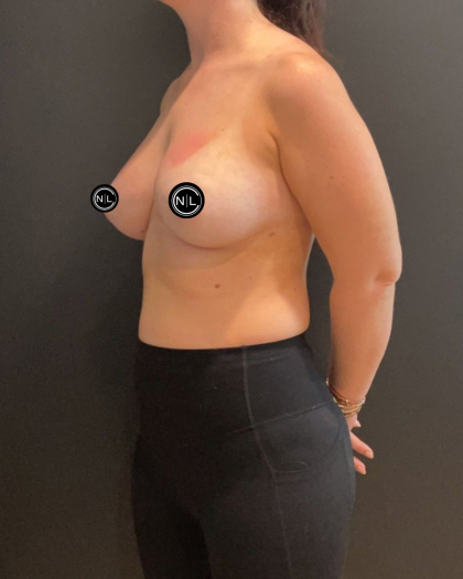 Breast Augmentation Before & After Patient #16681