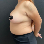 Breast Reduction Before & After Patient #16688