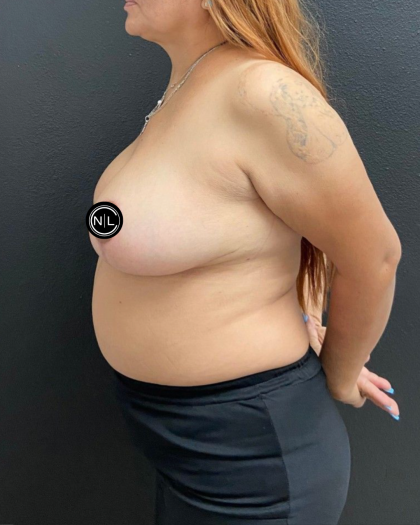 Breast Reduction Before & After Patient #16688