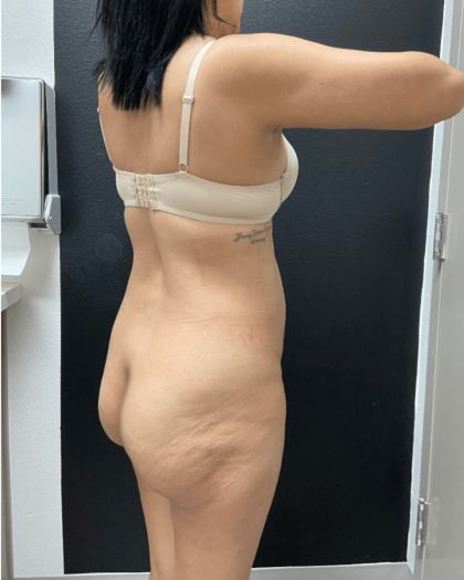 Mommy Makeover Before & After Patient #16691
