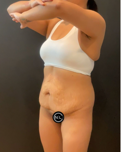 Mommy Makeover Before & After Patient #16692