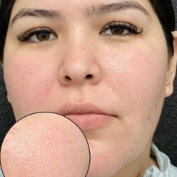 CO2 Laser Before & After Patient #16682