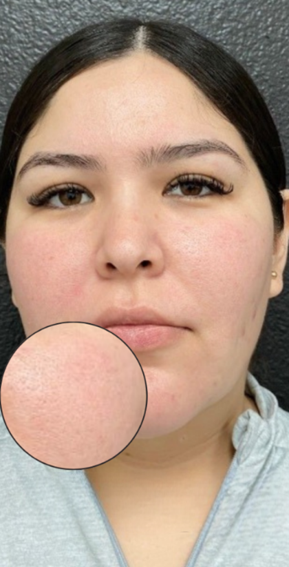 CO2 Laser Before & After Patient #16682