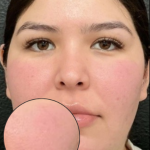 CO2 Laser Before & After Patient #16682