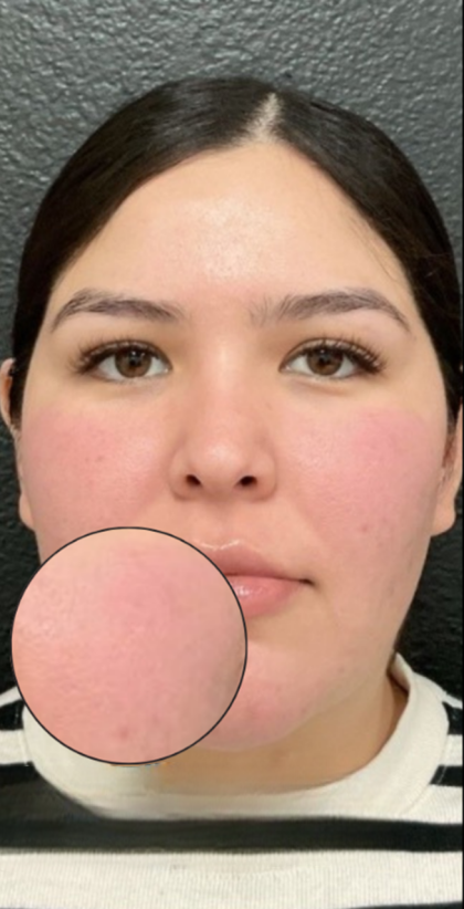 CO2 Laser Before & After Patient #16682
