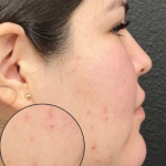 CO2 Laser Before & After Patient #16682