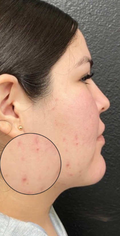 CO2 Laser Before & After Patient #16682