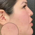 CO2 Laser Before & After Patient #16682
