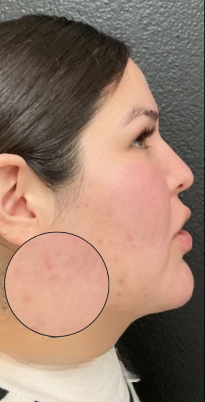 CO2 Laser Before & After Patient #16682