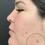 CO2 Laser Before & After Patient #16682