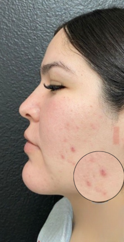 CO2 Laser Before & After Patient #16682