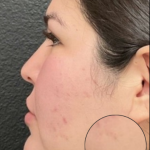 CO2 Laser Before & After Patient #16682
