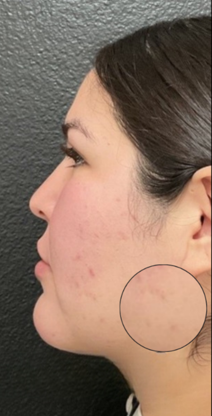 CO2 Laser Before & After Patient #16682