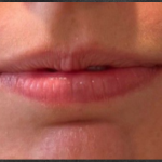 Lip Filler Before & After Patient #16768