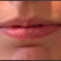 Lip Filler Before & After Patient #16768